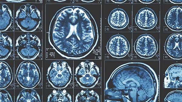 Composite image of multiple MRI brain scans in blue tones, highlighting various brain structures.